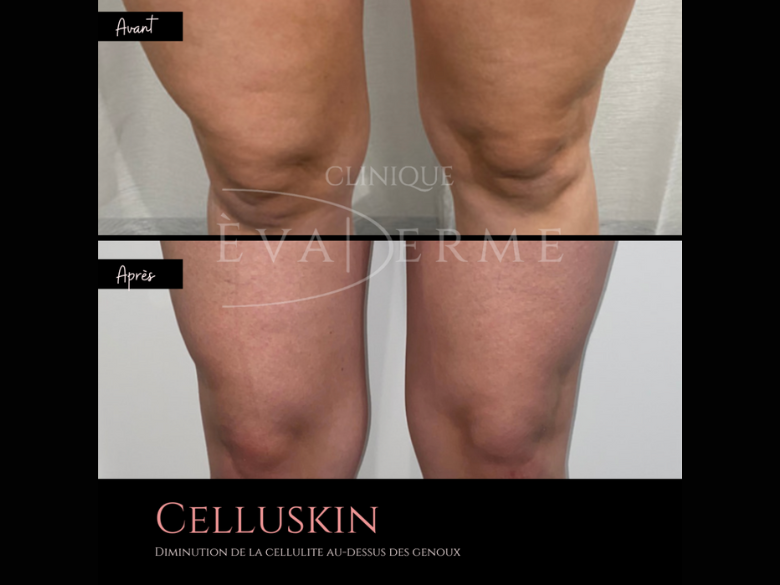Une séance de Celluskin 1 zone