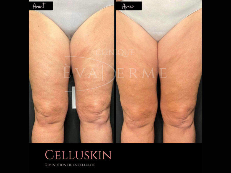 Photo – Èvaderme- celluskin – 1