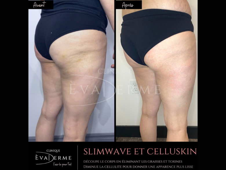 Photo – Èvaderme- celluskin – 1