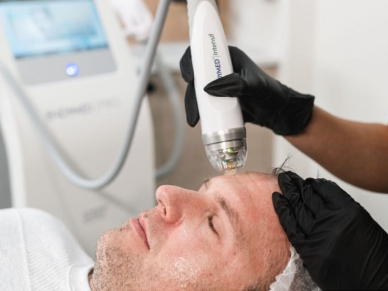 Photo – Axé Beauté – Microneedling – 1